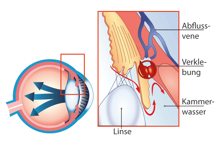 Intravitreale Injektion Schema