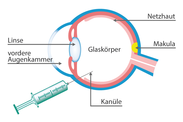 Intravitreale Injektionen